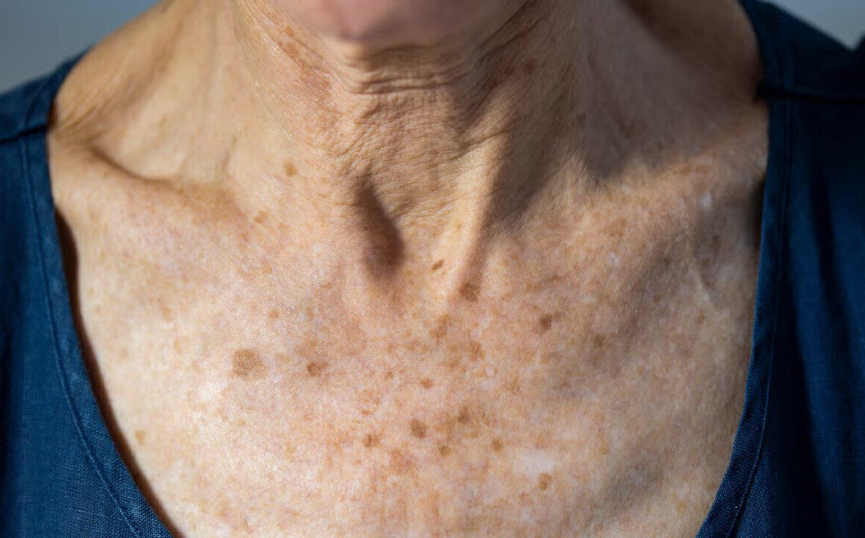 Liver Spots